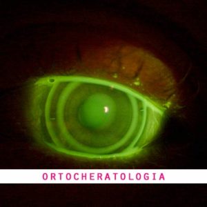 Lenti Ortocheratologia Lenti Ortocheratologia